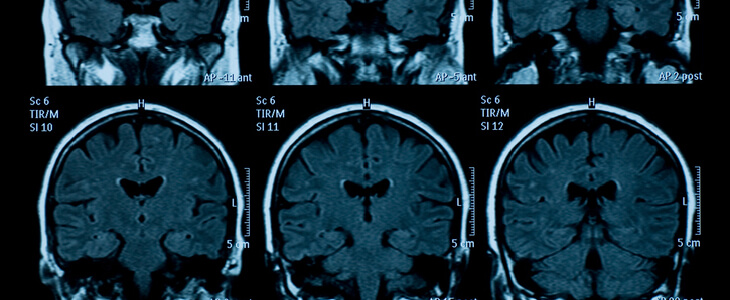 A CT scan revealing a brain injury in a victim