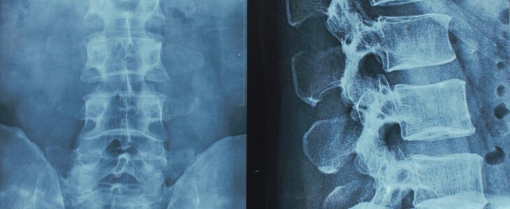 x-ray of the spine lumbar sacral
